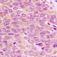 PBK / TOPK Antibody - Immunohistochemical analysis of TOPK (pT9) staining in human breast cancer formalin fixed paraffin embedded tissue section. The section was pre-treated using heat mediated antigen retrieval with sodium citrate buffer (pH 6.0). The section was then incubated with the antibody at room temperature and detected using an HRP conjugated compact polymer system. DAB was used as the chromogen. The section was then counterstained with hematoxylin and mounted with DPX.