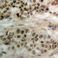 PBOV1 Antibody - Immunohistochemical analysis of PBOV1 staining in human prostate cancer formalin fixed paraffin embedded tissue section. The section was pre-treated using heat mediated antigen retrieval with sodium citrate buffer (pH 6.0). The section was then incubated with the antibody at room temperature and detected with HRP and DAB as chromogen. The section was then counterstained with hematoxylin and mounted with DPX.