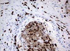 PBX1 Antibody - Immunohistochemical staining of paraffin-embedded Carcinoma of Human lung tissue using anti-PBX1 mouse monoclonal antibody.  heat-induced epitope retrieval by 10mM citric buffer, pH6.0, 120C for 3min)