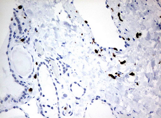 PBX1 Antibody - Immunohistochemical staining of paraffin-embedded Human thyroid tissue using anti-PBX1 mouse monoclonal antibody.  heat-induced epitope retrieval by 10mM citric buffer, pH6.0, 120C for 3min)