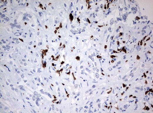 PBX1 Antibody - Immunohistochemical staining of paraffin-embedded Carcinoma of Human liver tissue using anti-PBX1mouse monoclonal antibody.  heat-induced epitope retrieval by 10mM citric buffer, pH6.0, 120C for 3min)