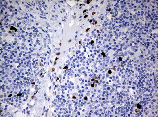 PBX1 Antibody - Immunohistochemical staining of paraffin-embedded Carcinoma of Human bladder tissue using anti-PBX1 mouse monoclonal antibody.  heat-induced epitope retrieval by 10mM citric buffer, pH6.0, 120C for 3min)