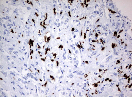 PBX1 Antibody - Immunohistochemical staining of paraffin-embedded Carcinoma of Human liver tissue using anti-PBX1 mouse monoclonal antibody.  heat-induced epitope retrieval by 10mM citric buffer, pH6.0, 120C for 3min)
