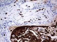 PBX1 Antibody - Immunohistochemical staining of paraffin-embedded Carcinoma of Human lung tissue using anti-PBX1mouse monoclonal antibody.  heat-induced epitope retrieval by 10mM citric buffer, pH6.0, 120C for 3min)