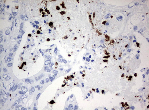 PBX1 Antibody - Immunohistochemical staining of paraffin-embedded Adenocarcinoma of Human colon tissue using anti-PBX1 mouse monoclonal antibody.  heat-induced epitope retrieval by 10mM citric buffer, pH6.0, 120C for 3min)