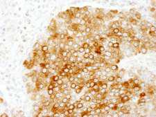 PBXIP1 / HPIP Antibody - Detection of Human HPIP/PBXIP1 by Immunohistochemistry. Sample: FFPE section of human pancreatic islet cell tumor. Antibody: Affinity purified rabbit anti-HPIP/PBXIP1 used at a dilution of 1:200 (1 Detection: DAB.
