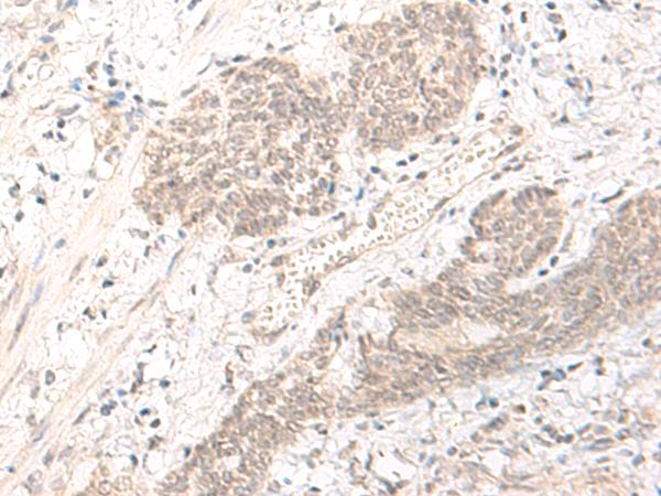 PBXIP1 / HPIP Antibody - Immunohistochemistry of paraffin-embedded Human esophagus cancer tissue  using PBXIP1 Polyclonal Antibody at dilution of 1:40(×200)