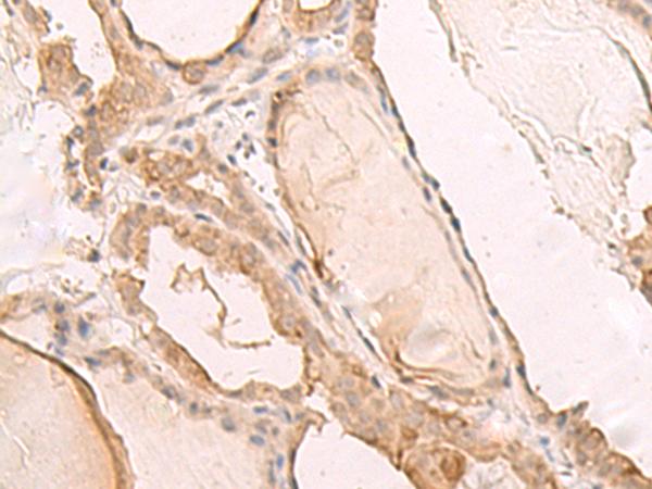 PBXIP1 / HPIP Antibody - Immunohistochemistry of paraffin-embedded Human thyroid cancer tissue  using PBXIP1 Polyclonal Antibody at dilution of 1:40(×200)