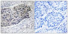 PC / Pyruvate Carboxylase Antibody - Immunohistochemistry analysis of paraffin-embedded human lung carcinoma tissue, using PC Antibody. The picture on the right is blocked with the synthesized peptide.