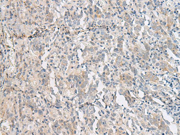PC5 / PCSK5 Antibody - Immunohistochemistry of paraffin-embedded Human cervical cancer tissue  using PCSK5 Polyclonal Antibody at dilution of 1:50(×200)