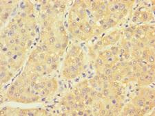 PCBD1 / PHS Antibody - Immunohistochemistry of paraffin-embedded human liver cancer using PCBD1 Antibody at dilution of 1:100