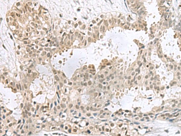 PCBD1 / PHS Antibody - Immunohistochemistry of paraffin-embedded Human breast cancer tissue  using PCBD1 Polyclonal Antibody at dilution of 1:60(×200)