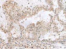 PCBD1 / PHS Antibody - Immunohistochemistry of paraffin-embedded Human breast cancer tissue  using PCBD1 Polyclonal Antibody at dilution of 1:60(×200)