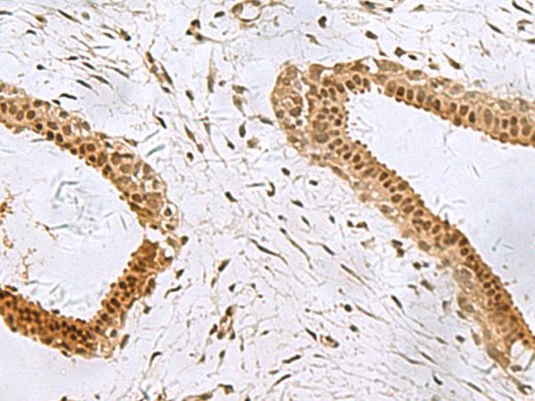 PCBD1 / PHS Antibody - Immunohistochemistry of paraffin-embedded Human breast cancer tissue  using PCBD1 Polyclonal Antibody at dilution of 1:90(×200)