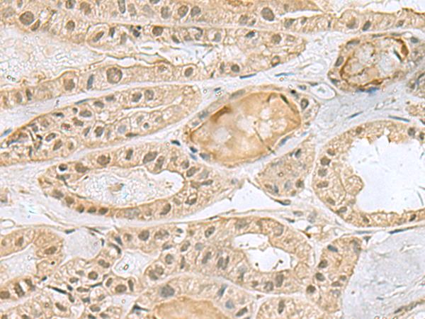 PCBD1 / PHS Antibody - Immunohistochemistry of paraffin-embedded Human thyroid cancer tissue  using PCBD1 Polyclonal Antibody at dilution of 1:90(×200)