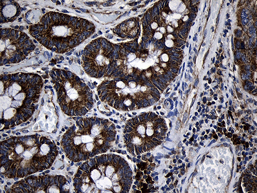 PCCA Antibody - Immunohistochemical staining of paraffin-embedded Adenocarcinoma of Human colon tissue using anti-PCCA mouse monoclonal antibody. (Heat-induced epitope retrieval by 1mM EDTA in 10mM Tris buffer. (pH8.5) at 120°C for 3 min. (1:500)