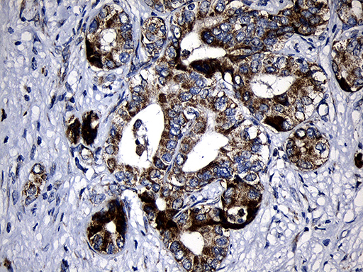 PCCA Antibody - Immunohistochemical staining of paraffin-embedded Carcinoma of Human liver tissue using anti-PCCA mouse monoclonal antibody. (Heat-induced epitope retrieval by 1mM EDTA in 10mM Tris buffer. (pH8.5) at 120°C for 3 min. (1:500)