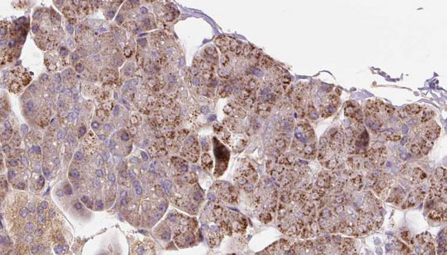 PCCA Antibody - 1:100 staining human pancreas carcinoma tissue by IHC-P. The sample was formaldehyde fixed and a heat mediated antigen retrieval step in citrate buffer was performed. The sample was then blocked and incubated with the antibody for 1.5 hours at 22°C. An HRP conjugated goat anti-rabbit antibody was used as the secondary.