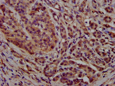 PCCB Antibody - Immunohistochemistry image at a dilution of 1:300 and staining in paraffin-embedded human pancreatic cancer performed on a Leica BondTM system. After dewaxing and hydration, antigen retrieval was mediated by high pressure in a citrate buffer (pH 6.0) . Section was blocked with 10% normal goat serum 30min at RT. Then primary antibody (1% BSA) was incubated at 4 °C overnight. The primary is detected by a biotinylated secondary antibody and visualized using an HRP conjugated SP system.