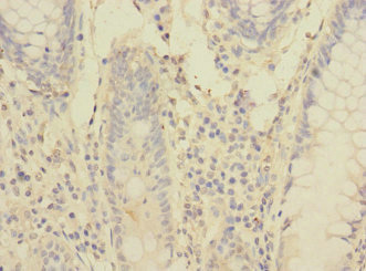 PCDH1 / PCD1 Antibody - Immunohistochemistry of paraffin-embedded human colon cancer at dilution 1:100