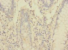 PCDH1 / PCD1 Antibody - Immunohistochemistry of paraffin-embedded human colon cancer at dilution 1:100