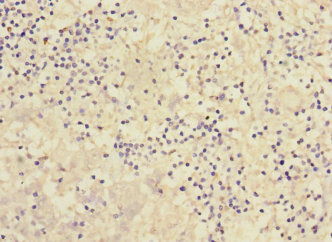 PCDH1 / PCD1 Antibody - Immunohistochemistry of paraffin-embedded human liver cancer at dilution 1:100