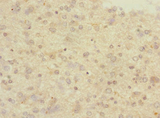PCDH10 Antibody - Immunohistochemistry of paraffin-embedded human glioma at dilution 1:100