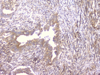 PCDH15 Antibody - IHC staining of FFPE human rectal cancer with PCDH15 antibody at 1ug/ml. HIER: boil tissue sections in pH6, 10mM citrate buffer, for 10-20 min followed by cooling at RT for 20 min.