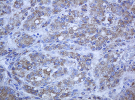PCDH7 Antibody - IHC of paraffin-embedded Carcinoma of Human liver tissue using anti-PCDH7 mouse monoclonal antibody. (Heat-induced epitope retrieval by 10mM citric buffer, pH6.0, 120°C for 3min).
