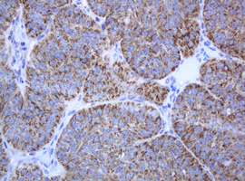 PCDH7 Antibody - IHC of paraffin-embedded Adenocarcinoma of Human ovary tissue using anti-PCDH7 mouse monoclonal antibody. (Heat-induced epitope retrieval by 10mM citric buffer, pH6.0, 120°C for 3min).