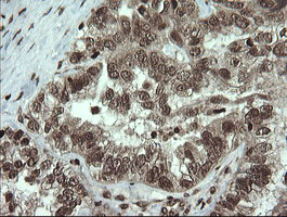 PCDH7 Antibody - IHC of paraffin-embedded Adenocarcinoma of Human ovary tissue using anti-PCDH7 mouse monoclonal antibody. (Heat-induced epitope retrieval by 10mM citric buffer, pH6.0, 100C for 10min).