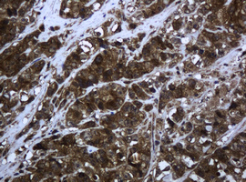 PCDH7 Antibody - IHC of paraffin-embedded Adenocarcinoma of Human colon tissue using anti-PCDH7 mouse monoclonal antibody. (Heat-induced epitope retrieval by 10mM citric buffer, pH6.0, 120°C for 3min).