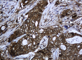 PCDH7 Antibody - IHC of paraffin-embedded Adenocarcinoma of Human breast tissue using anti-PCDH7 mouse monoclonal antibody. (Heat-induced epitope retrieval by 10mM citric buffer, pH6.0, 120°C for 3min).