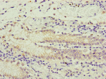 PCDHA12 Antibody - Immunohistochemistry of paraffin-embedded human gastric cancer at dilution of 1:100