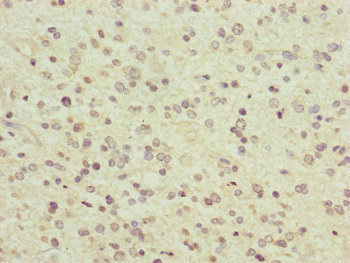 PCDHA12 Antibody - Immunohistochemistry of paraffin-embedded human glioma cancer at dilution of 1:100