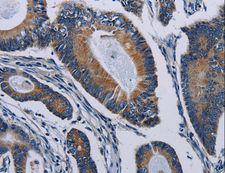PCDHAC2 Antibody - Immunohistochemistry of paraffin-embedded Human colon cancer using PCDHAC2 Polyclonal Antibody at dilution of 1:50.