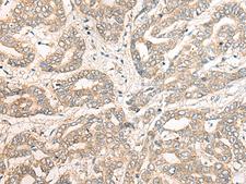 PCDHGB5 Antibody - Immunohistochemistry of paraffin-embedded Human liver cancer tissue  using PCDHGB5 Polyclonal Antibody at dilution of 1:40(×200)