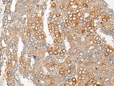 PCDHGB5 Antibody - Immunohistochemistry of paraffin-embedded Human liver cancer tissue  using PCDHGB5 Polyclonal Antibody at dilution of 1:35(×200)