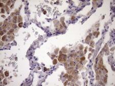 PCDHGC5 Antibody - Immunohistochemical staining of paraffin-embedded Carcinoma of Human lung tissue using anti-PCDHGC5 mouse monoclonal antibody. (Heat-induced epitope retrieval by Tris-EDTA, pH8.0)(1:150)