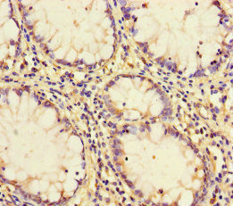 PCF11 Antibody - Immunohistochemistry of paraffin-embedded human colon cancer at dilution of 1:100