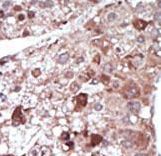 PCK1 Antibody - Formalin-fixed and paraffin-embedded human cancer tissue reacted with the primary antibody, which was peroxidase-conjugated to the secondary antibody, followed by DAB staining. This data demonstrates the use of this antibody for immunohistochemistry; clinical relevance has not been evaluated. BC = breast carcinoma; HC = hepatocarcinoma.