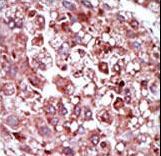 PCK1 Antibody - Formalin-fixed and paraffin-embedded human cancer tissue reacted with the primary antibody, which was peroxidase-conjugated to the secondary antibody, followed by AEC staining. This data demonstrates the use of this antibody for immunohistochemistry; clinical relevance has not been evaluated. BC = breast carcinoma; HC = hepatocarcinoma.
