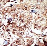 PCK2 / PEPCK Antibody - Formalin-fixed and paraffin-embedded human cancer tissue reacted with the primary antibody, which was peroxidase-conjugated to the secondary antibody, followed by AEC staining. This data demonstrates the use of this antibody for immunohistochemistry; clinical relevance has not been evaluated. BC = breast carcinoma; HC = hepatocarcinoma.
