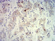 PCK2 / PEPCK Antibody - Immunohistochemical analysis of paraffin-embedded stomach cancer tissues using PCK2 mouse mAb with DAB staining.