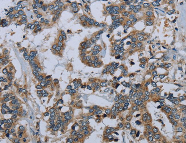 PCK2 / PEPCK Antibody - Immunohistochemistry of paraffin-embedded Human liver cancer using PCK2 Polyclonal Antibody at dilution of 1:60.