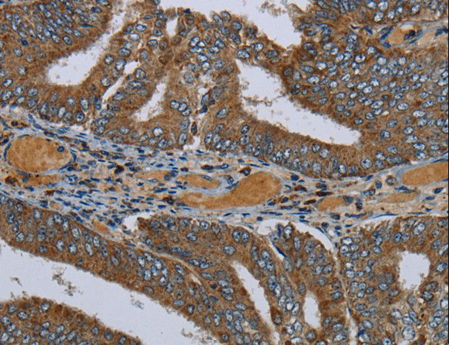 PCK2 / PEPCK Antibody - Immunohistochemistry of paraffin-embedded Human colon cancer using PCK2 Polyclonal Antibody at dilution of 1:60.