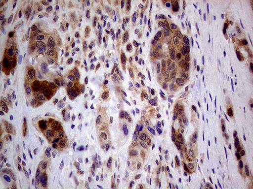 PCMT1 Antibody - Immunohistochemical staining of paraffin-embedded Adenocarcinoma of Human breast tissue tissue using anti-PCMT1 mouse monoclonal antibody. (Heat-induced epitope retrieval by 1mM EDTA in 10mM Tris buffer. (pH8.5) at 120°C for 3 min. (1:2000)