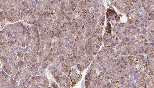 PCMT1 Antibody - 1:100 staining human pancreas carcinoma tissue by IHC-P. The sample was formaldehyde fixed and a heat mediated antigen retrieval step in citrate buffer was performed. The sample was then blocked and incubated with the antibody for 1.5 hours at 22°C. An HRP conjugated goat anti-rabbit antibody was used as the secondary.