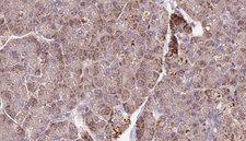 PCMT1 Antibody - 1:100 staining human pancreas carcinoma tissue by IHC-P. The sample was formaldehyde fixed and a heat mediated antigen retrieval step in citrate buffer was performed. The sample was then blocked and incubated with the antibody for 1.5 hours at 22°C. An HRP conjugated goat anti-rabbit antibody was used as the secondary.