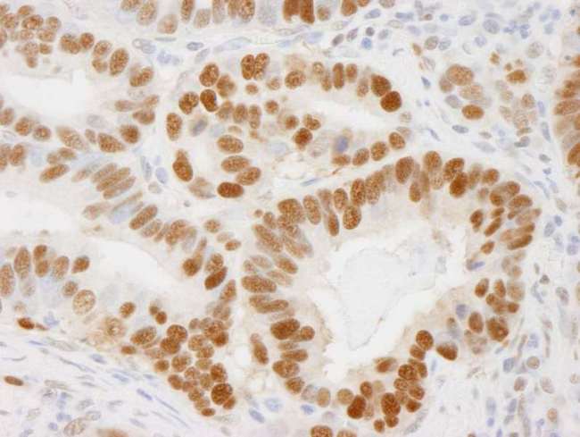 PCNA Antibody - Detection of Human PCNA by Immunohistochemistry. Sample: FFPE section of human stomach adenocarcinoma. Antibody: Affinity purified rabbit anti-PCNA used at a dilution of 1:250. Detection: DAB.